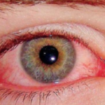 Health Authorities Warn of Eye Infection Risk in Flood-Affected Areas